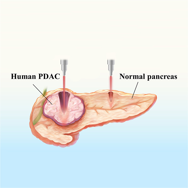 Laser targets pancreatic tumors by homing in on collagen