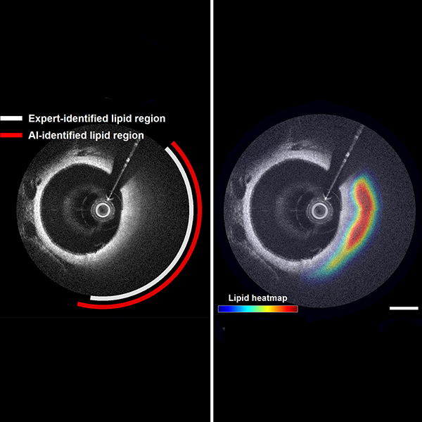 Combining AI with OCT shows potential for detecting lipid-rich plaques in coronary arteries