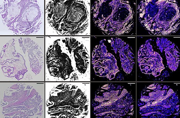The images show a 4x4 series of biological images in varying shades of purple and yellow. The Photothermal MIRSI images are of cervical cancer (rows A and B) and ovarian cancer (rows C and D) acquired by the a mid-infrared scanner (Column III).