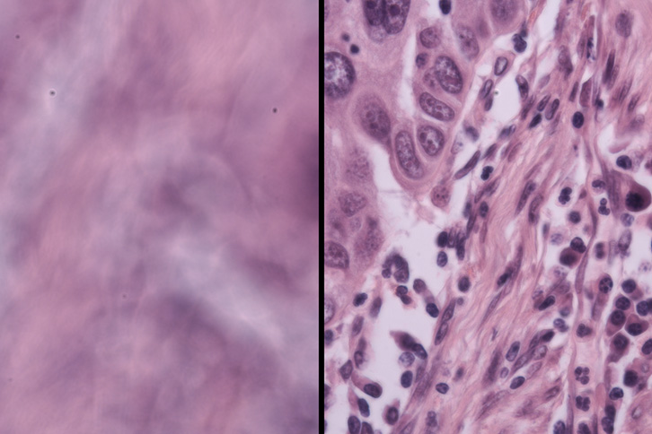 cancer tissue before and after DAbI digitally refocuses the image.